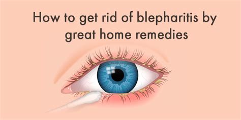 How to get rid of blepharitis by great home remedies