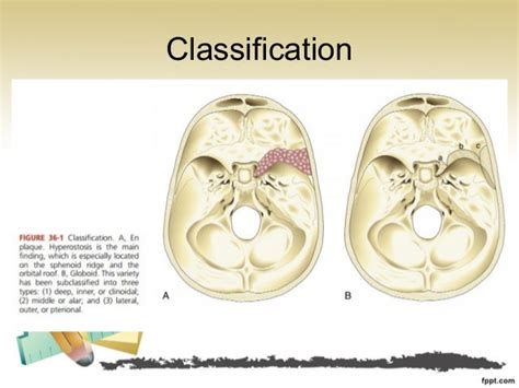 Sch.36 surgical management of sphenoid wing meningioma