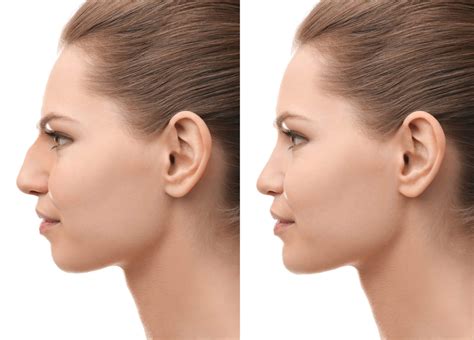 13 Tips to Speed Up Your Rhinoplasty Recovery Time