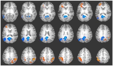 Bipolar Disorder and Brain Chemistry | SiOWfa15: Science in Our World ...