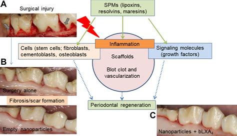 Inflammation and Periodontal Regeneration | Pocket Dentistry