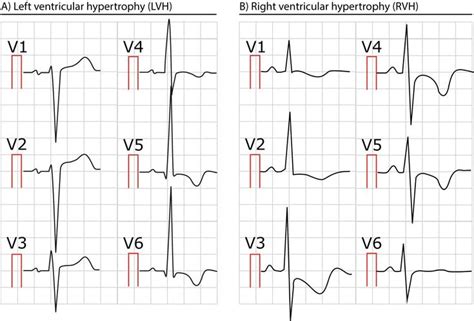 Figure 2. Two ECGs showing left and right ventricular hypertrophy. | Lvh, Medical knowledge, Ekg ...