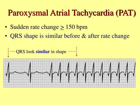 Paroxysmal Atrial Tachycardia