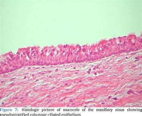 Figure 7 from Pathology Differential diagnosis of antral pseudocyst, surgical ciliated cyst, and ...