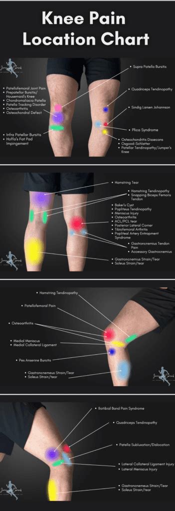 Knee Pain Location Chart | Learn the Pain Location of Knee Injuries