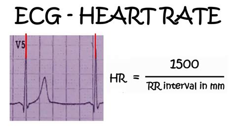 Ecg Heart Rate Calculation Formula - Printable Templates Protal