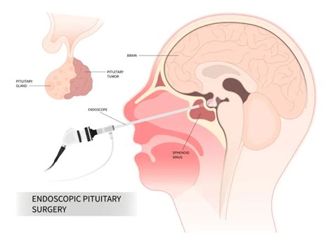 Pituitary Surgery and Tumours in Singapore - ENT Surgeon Dr Soma