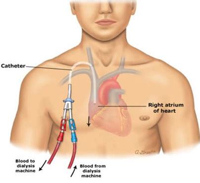 Permcath or Tunneled Catheter Insertion | Varicose veins | Vascular ...