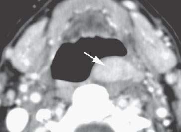 Hypopharynx: Benign Noninflammatory Masses and Tumors | Radiology Key