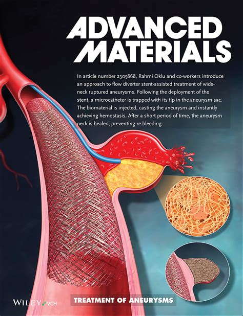 Treatment of Ruptured Wide‐Necked Aneurysms using a Microcatheter Injectable Biomaterial (Adv ...