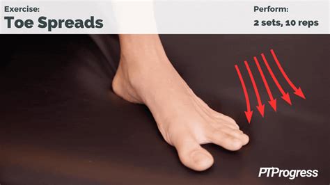 Bunion Exercises for Treating and Preventing a Bunion