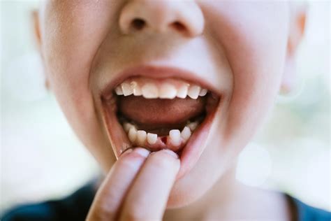 What Happens When Your Baby Teeth Fall Out Too Early? | CariFree