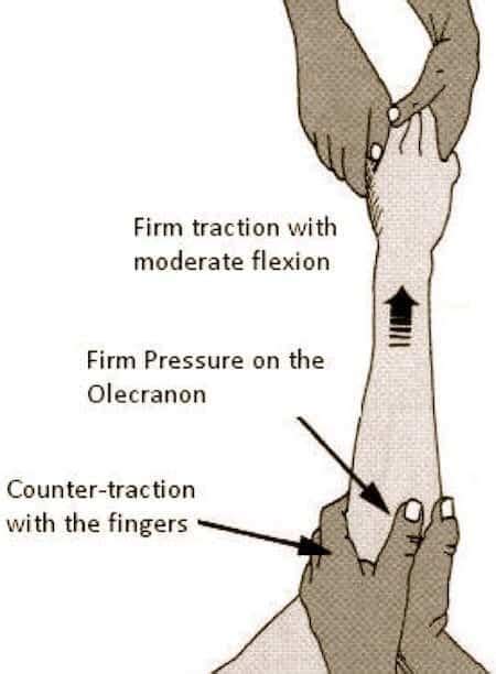 Elbow Dislocation • LITFL • Trauma Library