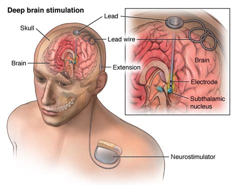 Deep Brain Stimulation | Medical Tourism with MediGlobus: The best ...