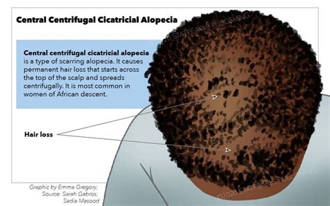 [Figure, Central Centrifugal Cicatricial Alopecia. Central...] - StatPearls - NCBI Bookshelf