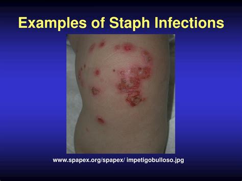 PPT - Skin Infections In Athletics PowerPoint Presentation - ID:60417