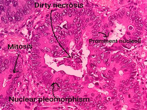 Pathology of Adenocarcinoma-Colon - Pathology Made Simple