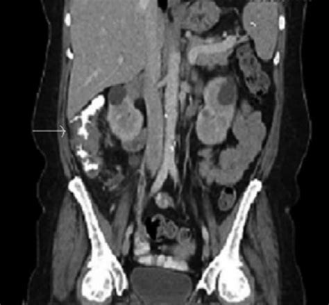 CT scan of abdomen with contrast with apple-core lesion in ascending ...