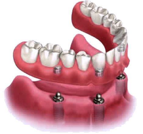 Implant Supported Denture - DDS Dentist Savannah GA | Mark Dye, DMD