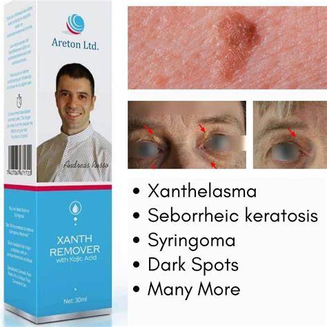 Xanthremover 70% Glycolic Acid Peel, Seborrheic Keratosis, Xanthelasma ...