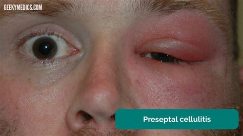 Cellulitis Treatment