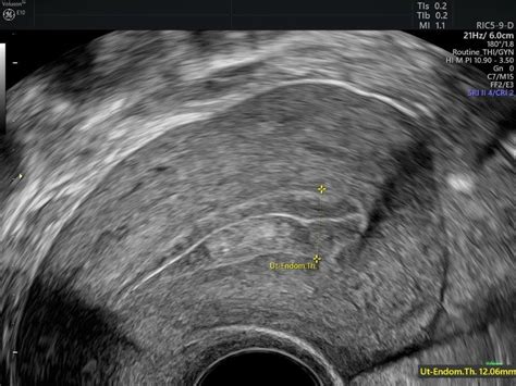 [36+] Uterine Cancer Ultrasound Endometrial Hyperplasia