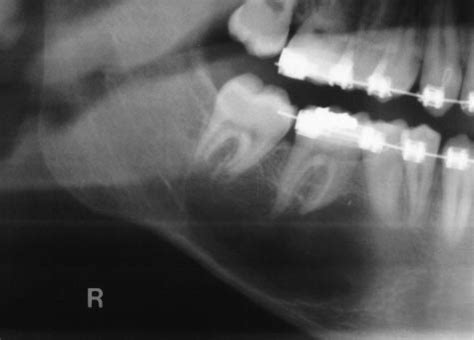 (a) Case III: Initial panoramic radiograph image showing a simple bone... | Download Scientific ...