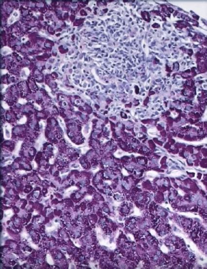 Mycobacterium Marinum - Infections Bacteria Skin Orthop...