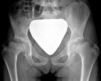 Legg-Calvé-Perthes Disease: Diagnosis, Imaging, and Classifications | Radiology Key