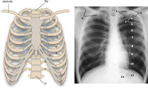 Slagter - Drawing and Chest X-ray of the ribs and clavicula - Latin labels | AnatomyTOOL