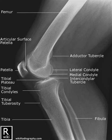 Lateral Knee | Radiology student, Radiology schools, Medical knowledge