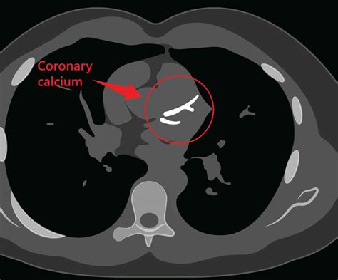 Coronary Calcium Score - Capital Heart Centre