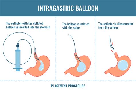 Gastric Balloon | Dubai Gastroenterology Clinic