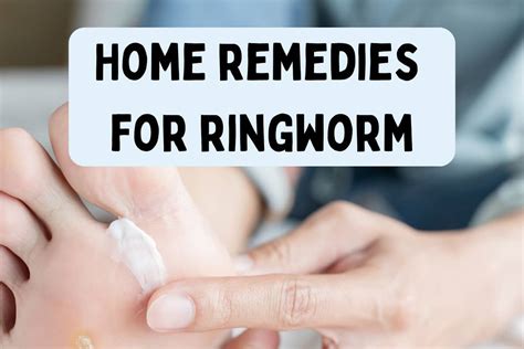 Home Remedies for Ringworm: How to treat it at home naturally?