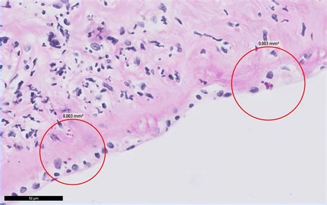 Candida glabrata chorioamnionitis in a twin pregnancy following in vitro fertilisation: a rare ...