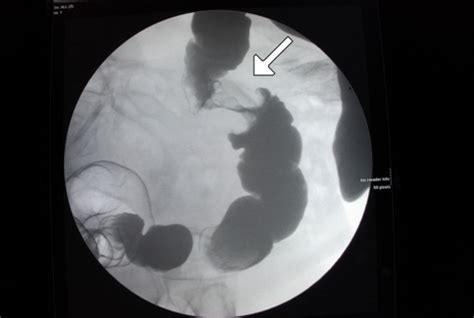 Apple-core lesion of the colon shown on barium enema (a | Open-i