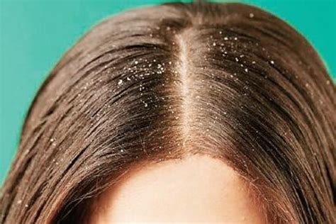 Dandruff vs Dry scalp: How Are They Different? | Health Blog - Read Health Advice on vitaminsicilik