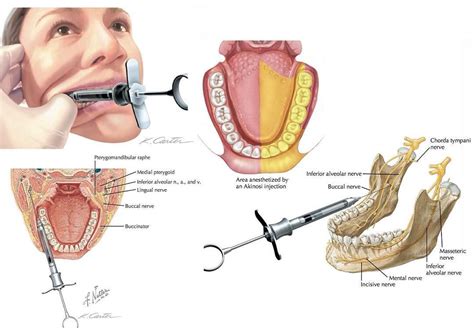 Long Buccal Nerve Block - JulienabbRojas