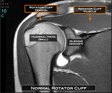 Rotator Cuff Tear Austin, TX | Shoulder Surgery Austin, TX | Shoulder Injury Round Rock