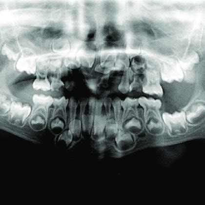 Preoperative orthopantomogram. | Download Scientific Diagram