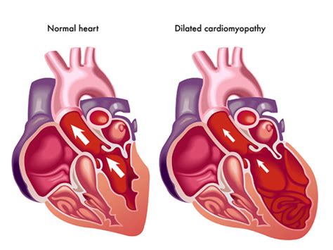 Cardiomyopathy: What Causes an Enlarged Heart? - University Health News