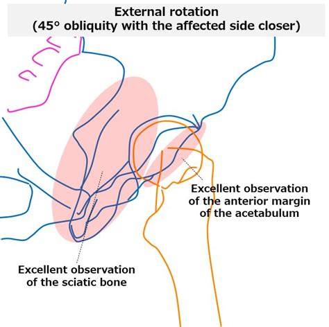 Hip joint oblique view, Judet method, Teufel method, False profile view｜Tools for RadTech