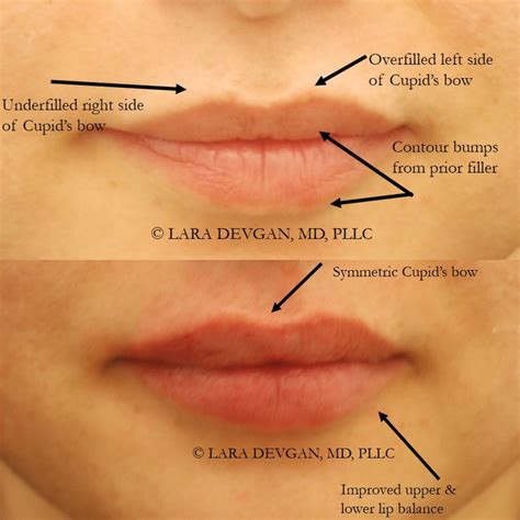 Correcting lip filler that is lumpy and bumpy — Lara Devgan, MD, MPH ...