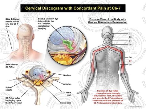 Cervical Radiculopathy Treatment