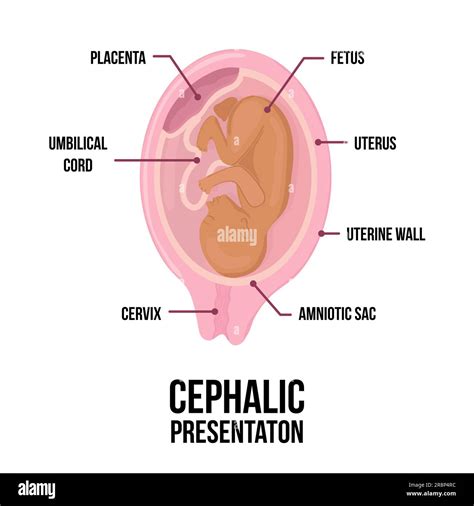 Cephalic presentation hi-res stock photography and images - Alamy