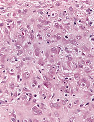 Pathology Outlines - Fibrous histiocytoma-epithelioid