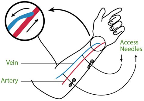 Types of Body Access for Dialysis | ORN