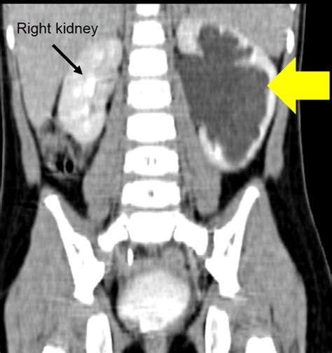 Congenital pelviureteric junction obstruction – Radiology Cases