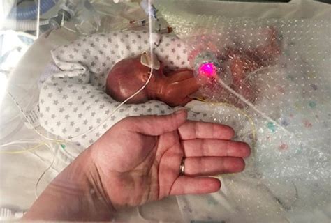 Premature baby born at 22 weeks thrives, hailed 'a miracle' - MadeForMums