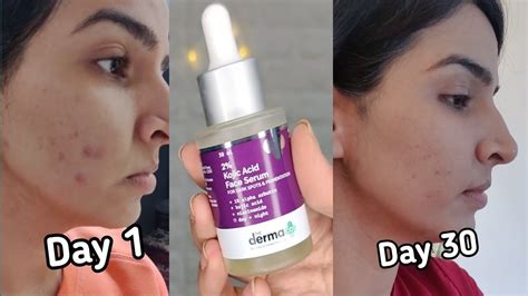 The Derma Co 2% Kojic Acid Serum + Soap Review | Best Serum for Dark spots, acne scars ...